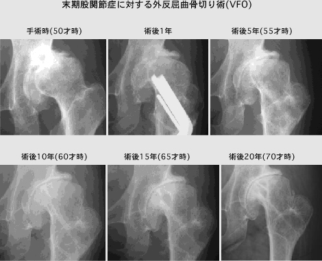 末期股関節症に対する外反屈曲骨切り術(VFO)