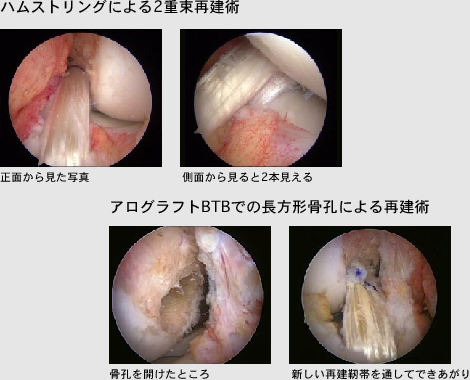 ハムストリングによる2重束再建術 アログラフトBTBでの長方形骨孔による再建術