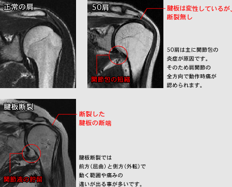 50肩は主に関節包の炎症が原因です。そのため肩関節の全方向で動作時痛が認められます。腱板断裂では前方（屈曲）と側方（外転）で動く範囲や痛みの違いが出る事が多いです。