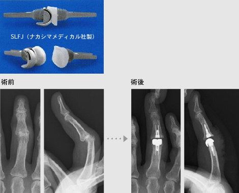 SLFJ（ナカシマメディカル社製）