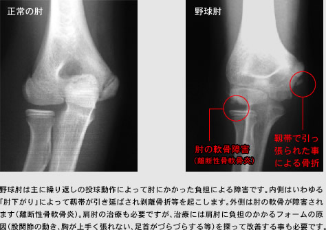 野球肘は主に繰り返しの投球動作によって肘にかかった負担による障害です。内側はいわゆる「肘下がり」によって靱帯が引き延ばされ剥離骨折等を起こします。外側は肘の軟骨が障害されます（離断性骨軟骨炎）。肩肘の治療も必要ですが、治療には肩肘に負担のかかるフォームの原因（股関節の動き、胸が上手く張れない、足首がづらづらする等）を探って改善する事も必要です。